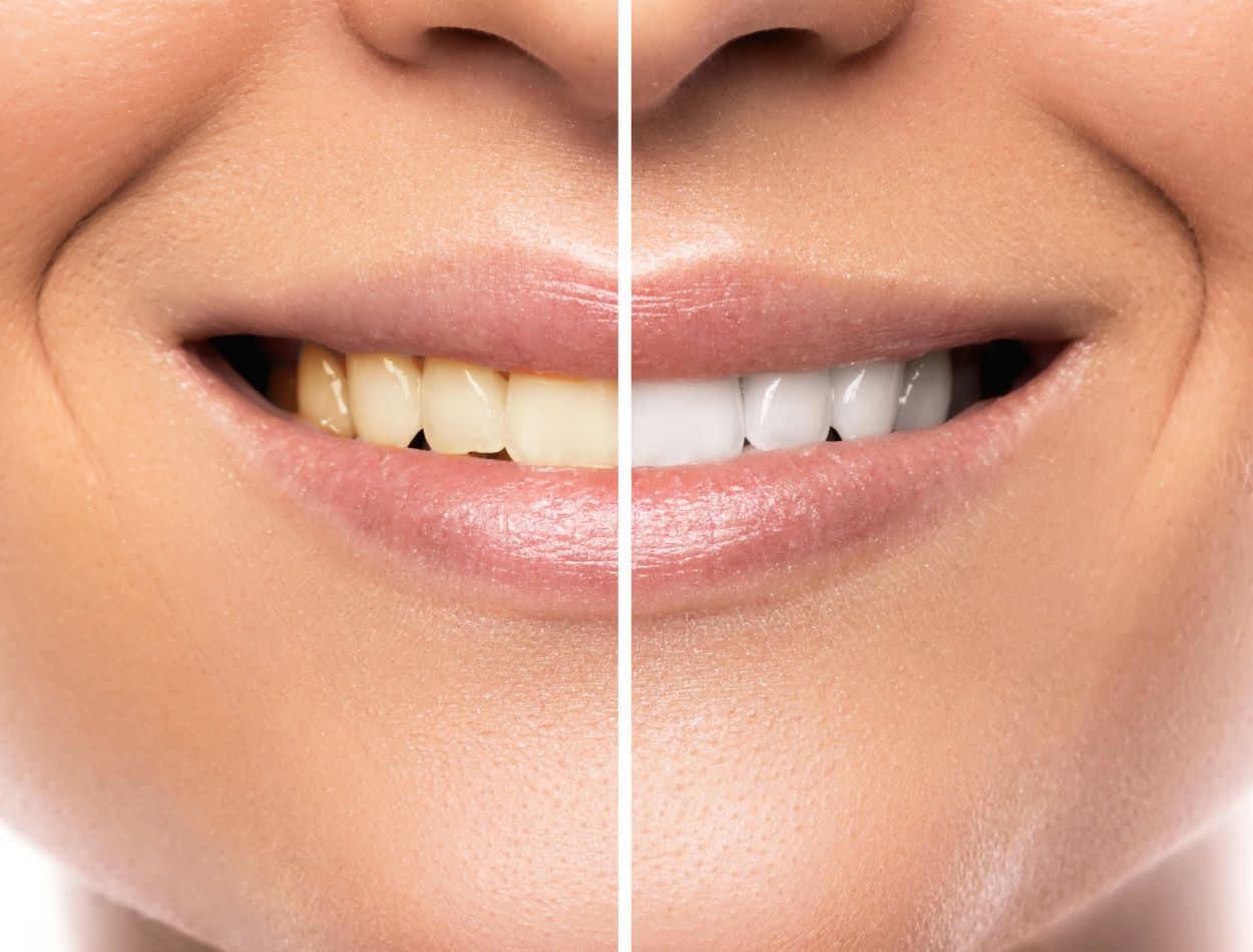 Clareamento Dental; veja tudo que você precisa saber sobre o assunto 1 Clareamento Dental