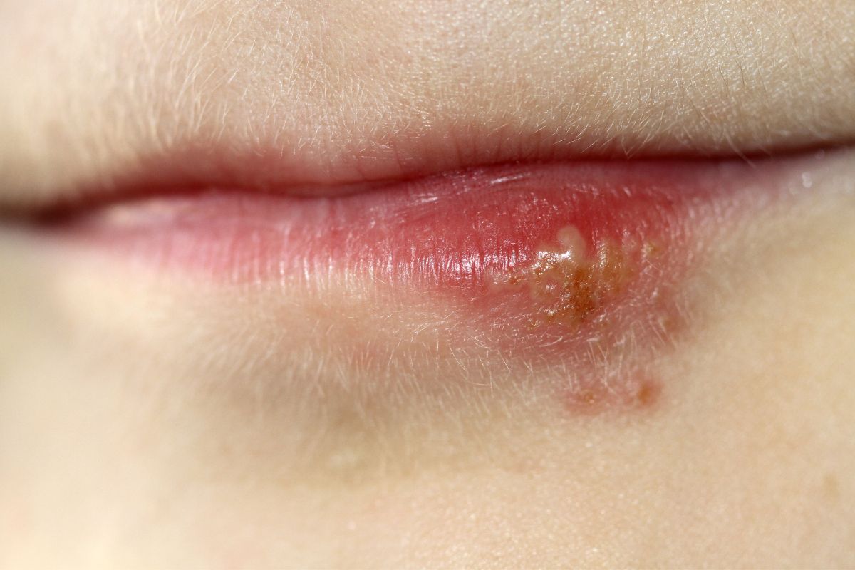 Quanto tempo dura herpes labial? Saiba os cuidados que você precisa ter 1 Quanto tempo dura herpes labial
