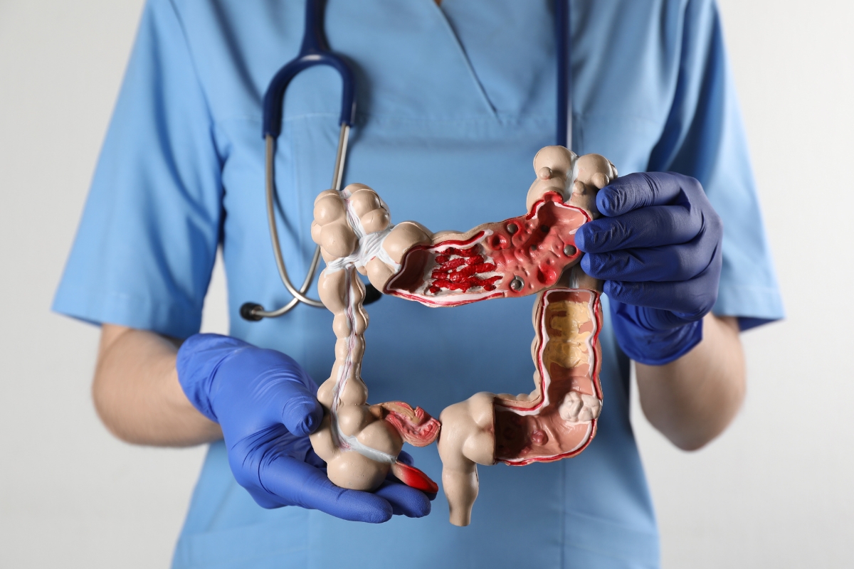 Veja as 5 dicas essenciais para prevenir câncer de intestino 1 Veja as 5 dicas essenciais para prevenir câncer de intestino