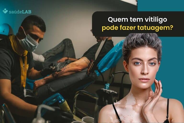 Quem tem vitiligo pode fazer tatuagem? Entenda a condição de saúde 1 Quem tem vitiligo pode fazer tatuagem.
