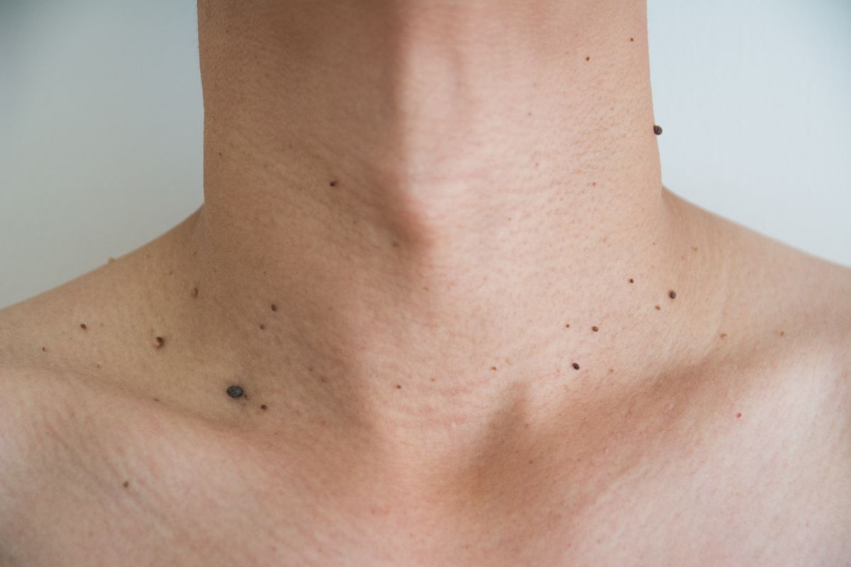 Verrugas no pescoço: causas, tratamentos e como prevenir 1 verrugas no pescoço.