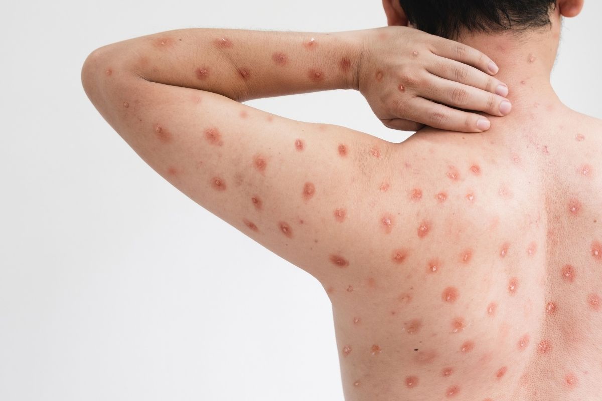 O que é Mpox e quais seus sintomas? Nova variante chega ao Brasil e é 10 vezes mais perigosa 1 O que é Mpox?