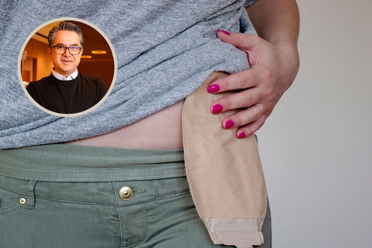 O que é ostomia.